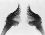 Radiografía de pies de loto